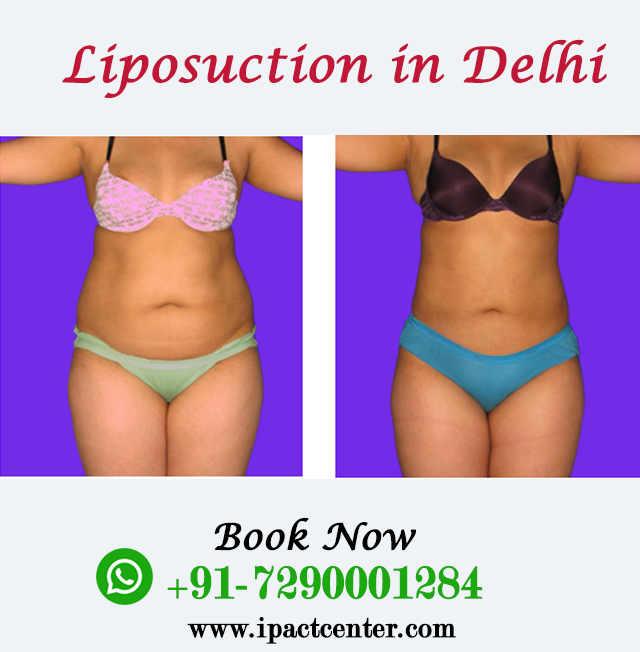 Liposuction in Delhi at Affordable&nbsp;Cost